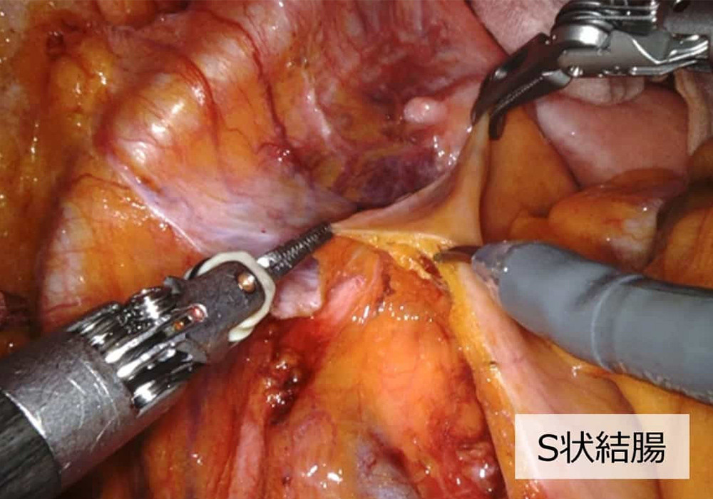 写真：ロボット支援結腸手術の一場面4
