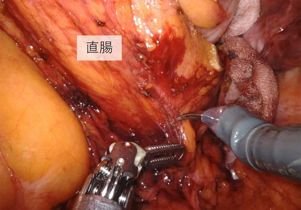 写真：ロボット支援結腸手術の一場面6
