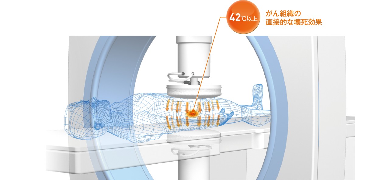 図：ハイパーサーミアの様子。がん組織中央部分には42〜44℃の熱を与える。正常細胞である周辺部分には40〜42℃の熱を与える。